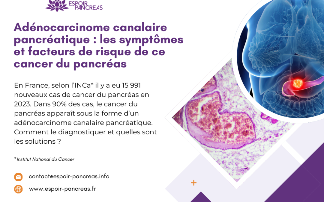 Adénocarcinome canalaire pancréatique : les symptômes et facteurs de risque de ce cancer du pancréas